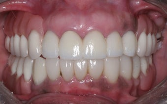 Smile makeover