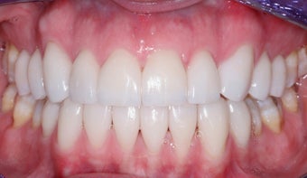 Veneers