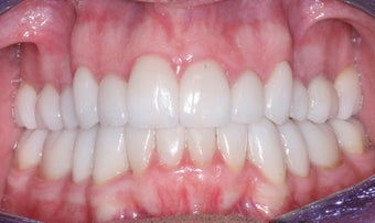 Smile makeover with Invisalign and Crowns