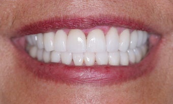 Smile makeover
