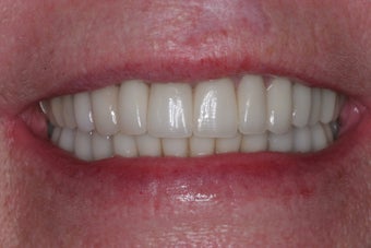 Smile makeover