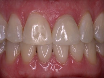 Smile Makeover