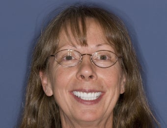 Smile Makeover