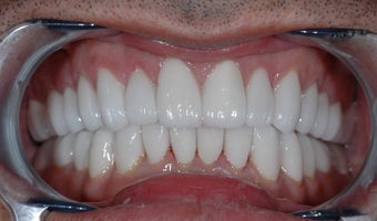 Smile Makeover with Porcelain Crowns