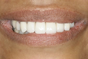 Full Mouth Restoration 