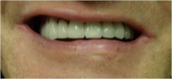 Full mouth Rehabilitation (Smile Makeover)