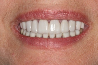 Porcelain Veneers