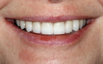 Full Mouth Reconstruction