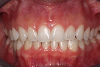 Braces, Gingivectomy, Bonding, Porcelain Crowns, Implant
