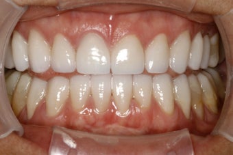 Full Mouth Smilemaker after treating TMJ