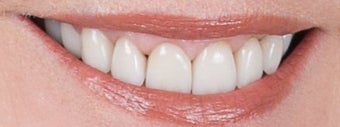 Orthodontics, all porcelain veneers, gum re-contouring