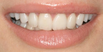 Dental implants, all porcelain restorations, gum re-contouring