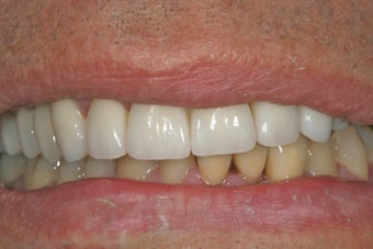 Dental implants, bone graft, all porcelain crowns and veneers