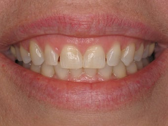 Gingival recontouring, Porcelain Veneers
