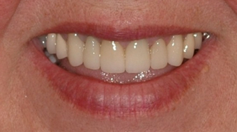 Porcelain Veneers and Dental Crowns
