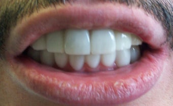 Snap-on Smile