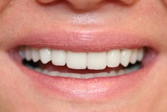 veneer and crown work