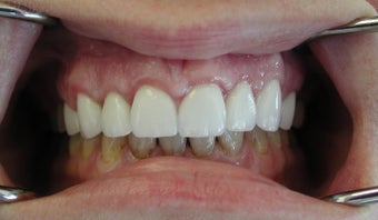 Gum lift (Crown Lengtheing), Root coverage with soft tissue Graft, 