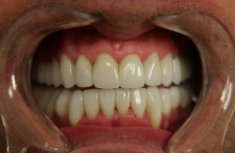 smile makeover with porcelain veneers