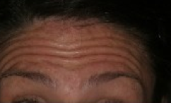 Botox