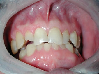smile makeover