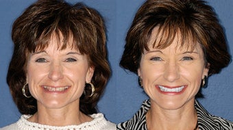 Smile Makeover