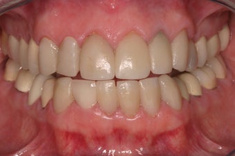 replacement of old restorations and new smile design