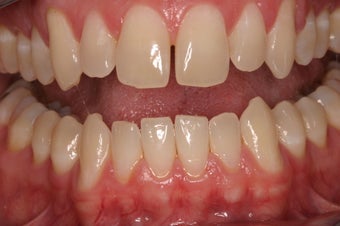 Porcelain Crowns 
