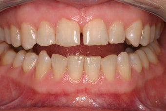 porcelain crowns to close space