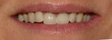 Veneers