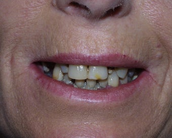Sedation Dentistry