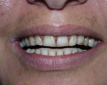 Crowns, Implants and Veneers