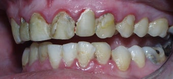Sedation Dentistry