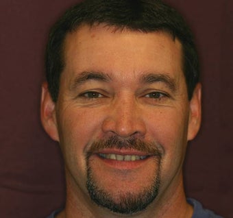 Full Mouth Reconstruction