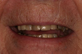 Full mouth rehabilitation.