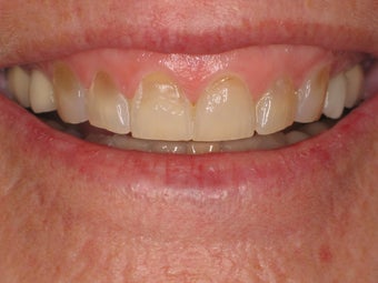 Smile Makeover