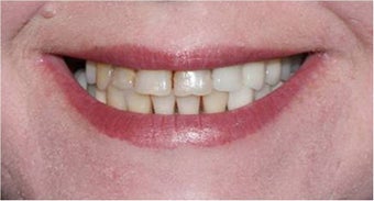 Smile Makeover with crowns and veneers