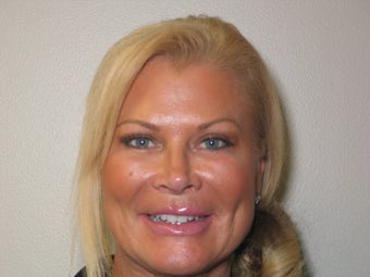 Full Mouth Smile Makeover