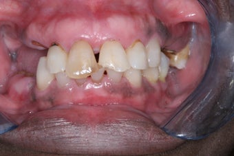 Smile makeover