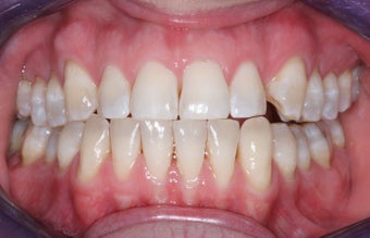 Veneers