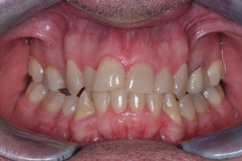 Smile makeover with Invisalign and Crowns