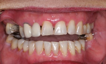 Smile makeover