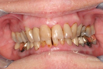 Smile makeover