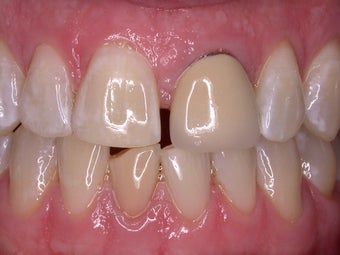 Smile Makeover