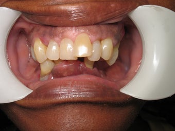 Smile makeover