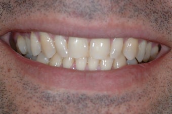 Smile Makeover with Porcelain Crowns