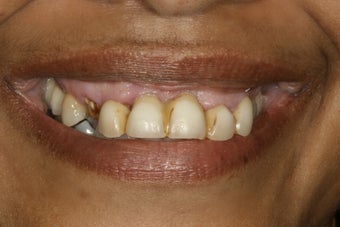 Full Mouth Restoration 