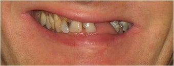 Full mouth Rehabilitation (Smile Makeover)