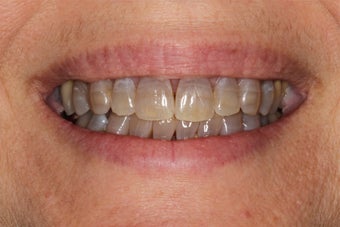 Porcelain Veneers