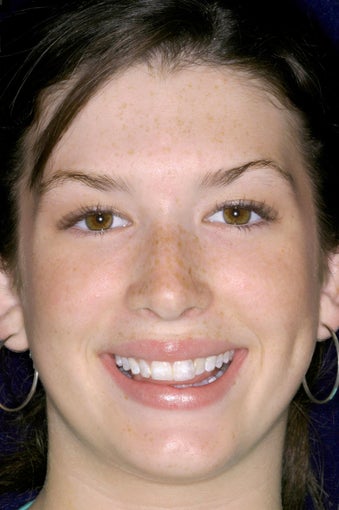 Porcelain Veneers